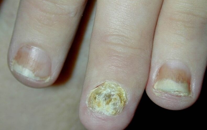hand nail psoriasis