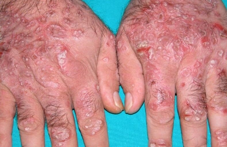 teardrop psoriasis on the hands