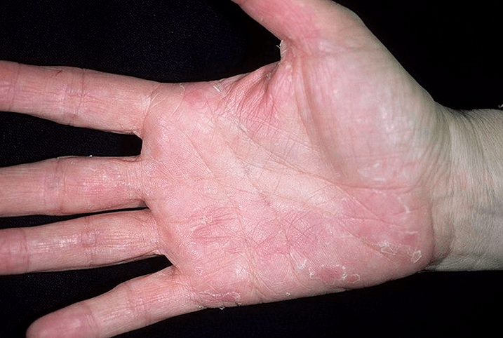 psoriasis on the palm and below