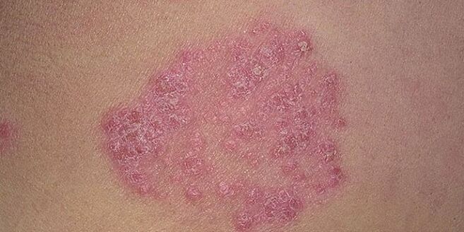 papula on the skin of the legs with psoriasis
