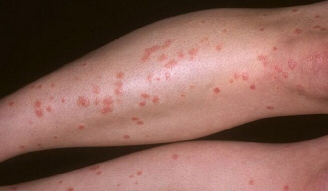 tears of psoriasis on the legs