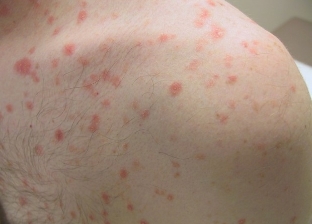 In the initial phase of psoriasis