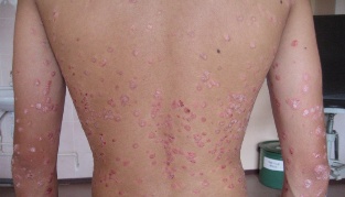 How to treat psoriasis fast