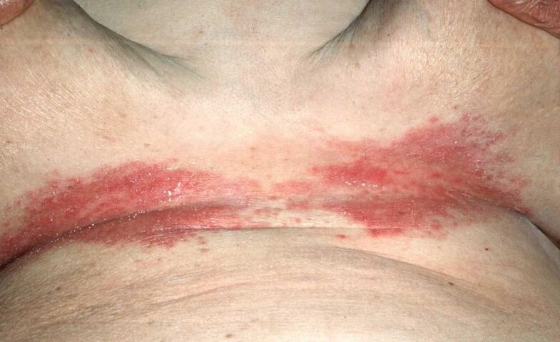 Psoriasis plaques under the breast