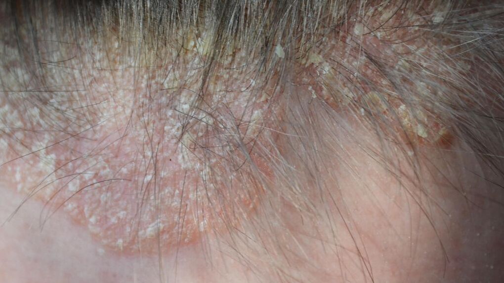 psoriasis on the head photo 4
