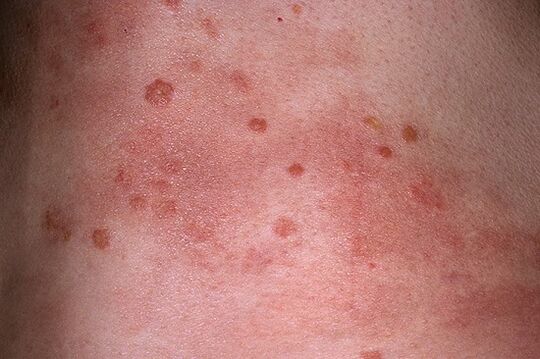 the progressive stage of the course of psoriasis