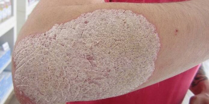 photo of psoriasis on the elbow