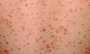how psoriasis early stage