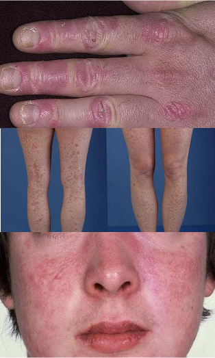 how psoriasis on the hands, feet and face