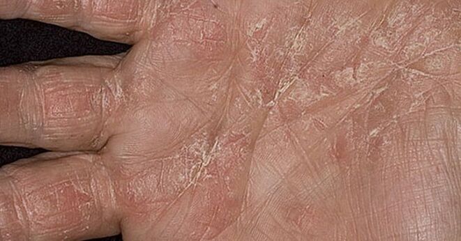 psoriasis on the palm