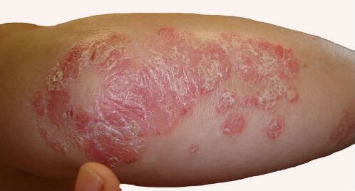 Scaly, voluminous plaques on the elbows during an exacerbation of psoriasis