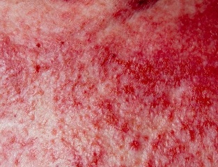 An advanced form of psoriasis