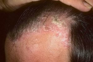 Posriasis of the scalp