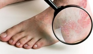 psoriasis therapeutic options
