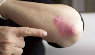 the stationary stage of development of psoriasis