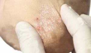 treatment of psoriasis during the attenuation phase