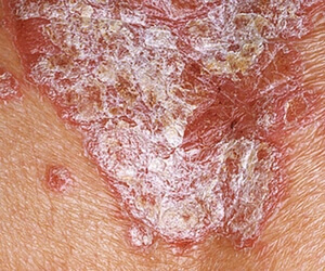 The stationary phase of psoriasis