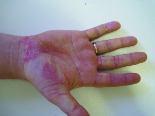 Pustules on the palms and soles