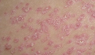 In the initial phase of psoriasis