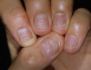 psoriasis of the nail